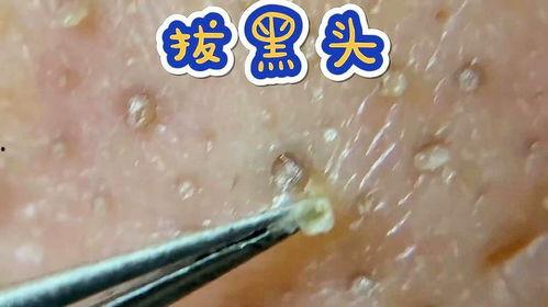 黑头视频,揭秘黑头成因及有效去除方法