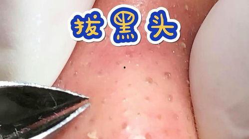 黑头视频,揭秘黑头成因及有效去除方法