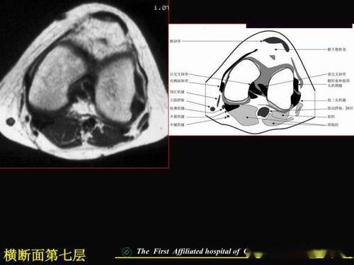 半月板视频,视频解析与康复指导