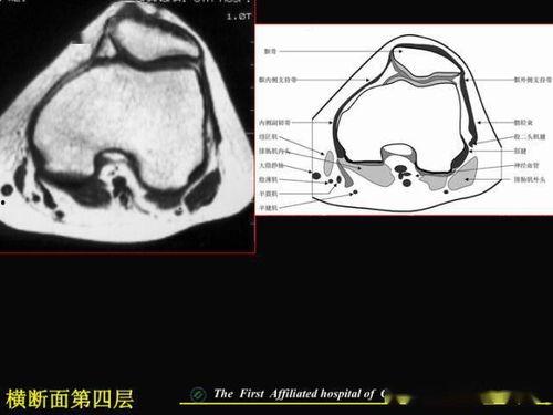 半月板视频,视频解析与康复指导
