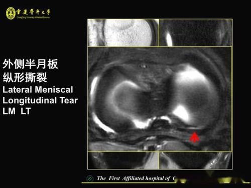 半月板视频,视频解析与康复指导