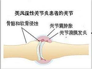 类风湿关节炎按摩视频,专业按摩视频教程解析